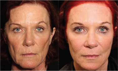 non surgical facelift results before after mississauga oakville toronto