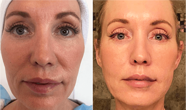 plla thread lift results before after mississauga oakville