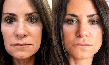 thread lift non surgical facelift results before after mississauga oakville toronto