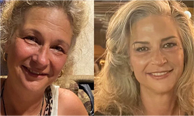 plla thread lift results before after mississauga oakville