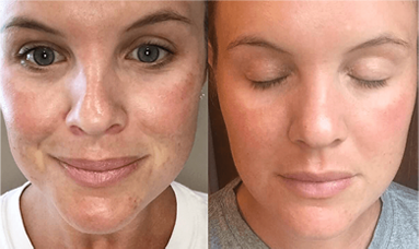 thread lift face lift results before after mississauga oakville