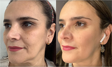 thread lift face lift results before after mississauga oakville