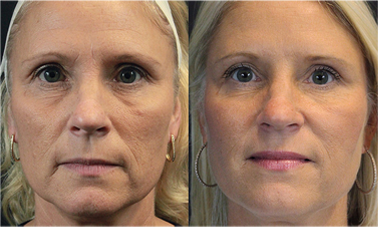 thread lift non surgical facelift results before after mississauga oakville toronto
