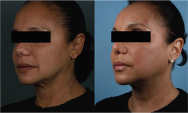 thread lift results before after mississauga oakville toronto